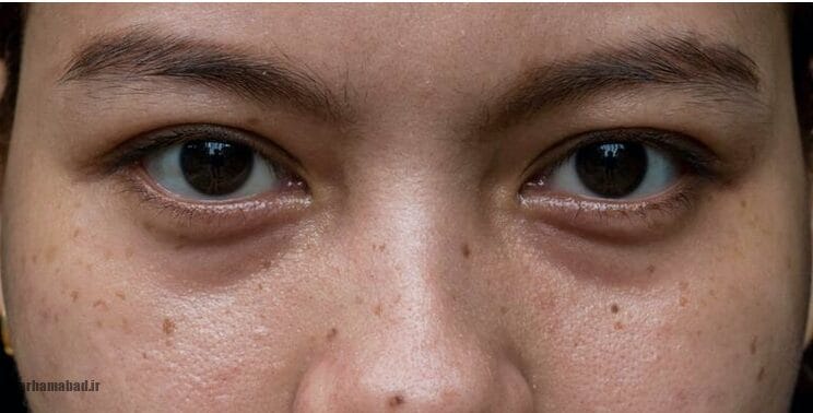 درمان‌ طبیعی از بین بردن تیرگی و پف زیر چشم!