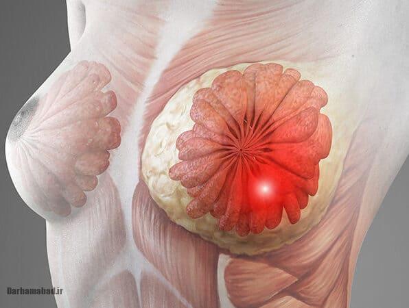 آیا سرطان سینه ارثی است؟ بررسی علمی نقش ژن_ها در بروز بیماری