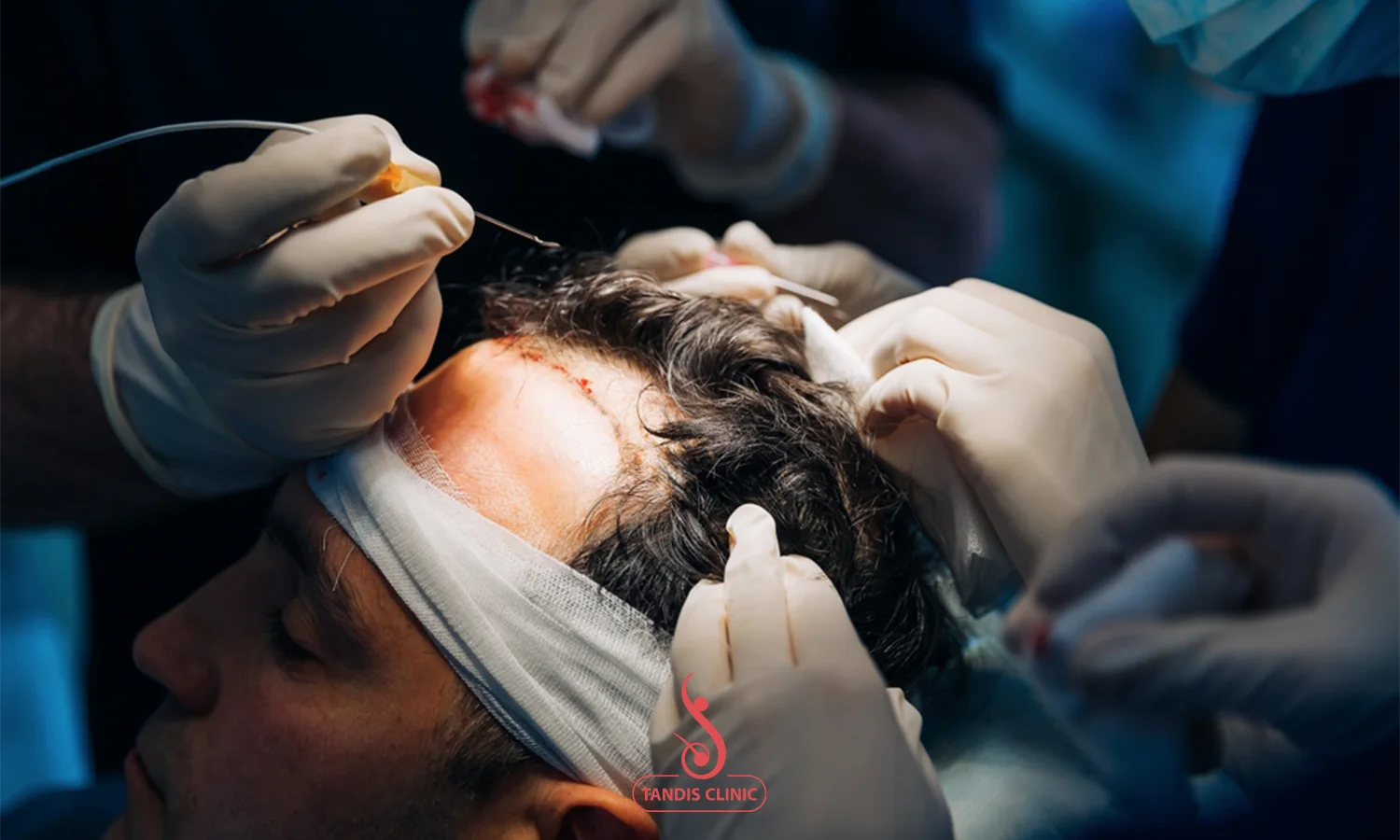 هزینه میکروکاشت مو و ریش در ایران