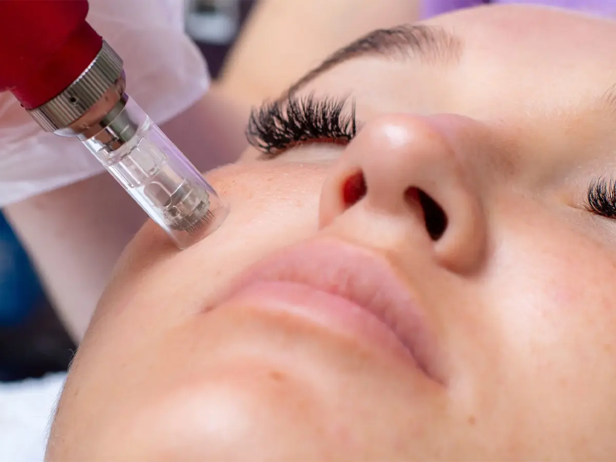 میکرونیدلینگ خانگی