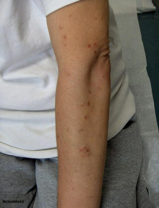 علائم اعتیاد شیشه علائم اعتیاد شیشه