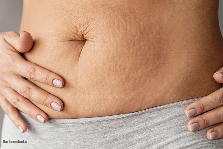 ترکهای بارداری ترکهای بارداری