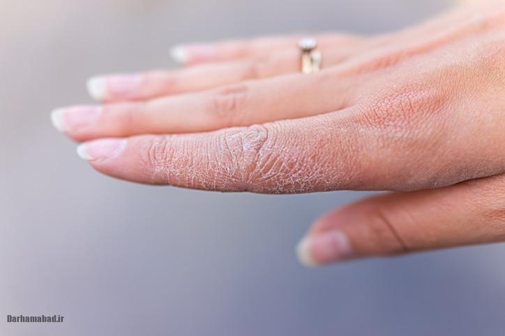 رفع خشکی پوست رفع خشکی پوست