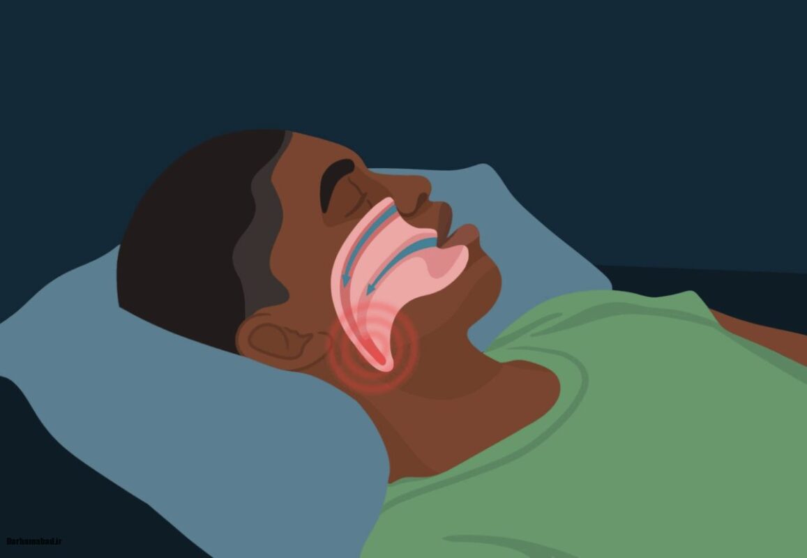 آپنه خواب چیست؟ آپنه خواب چیست؟