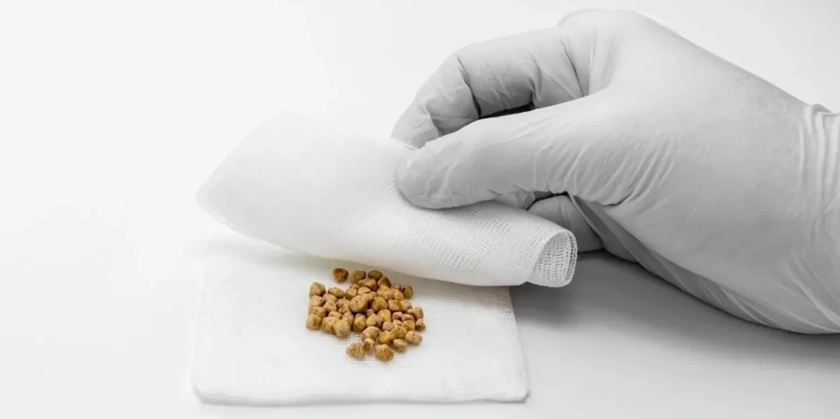 سنگ کیسه صفرا (2)