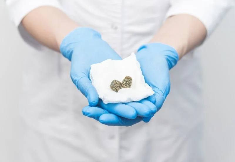 سنگ کیسه صفرا