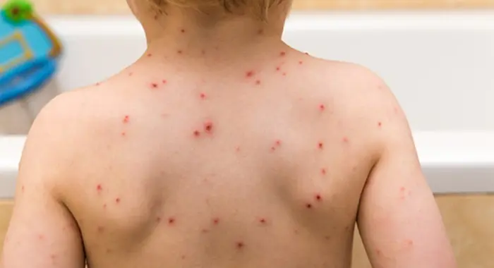 فرق آبله مرغان و سرخک (4)