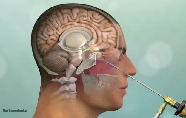 نشت CSF چیست؟ (2) نشت CSF چیست؟ (2)