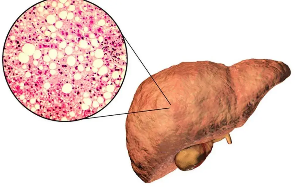 هپاتیت چیست؟ (3)
