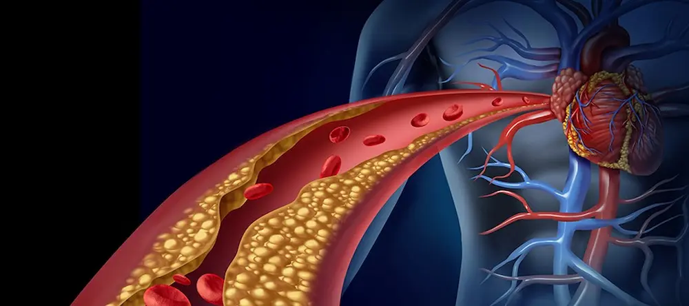 کاهش چربی خون (2) کاهش چربی خون (2)