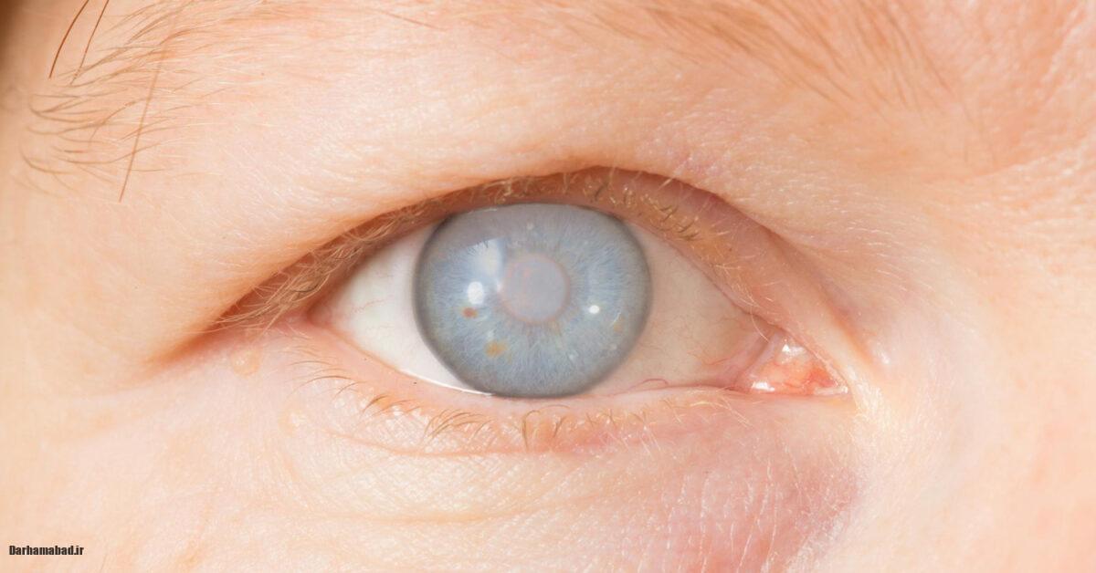 آب مروارید چشم چه علائمی دارد (2)