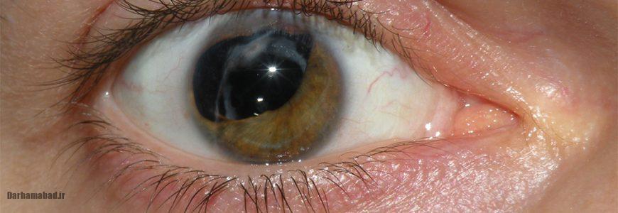 آب مروارید چشم چه علائمی دارد