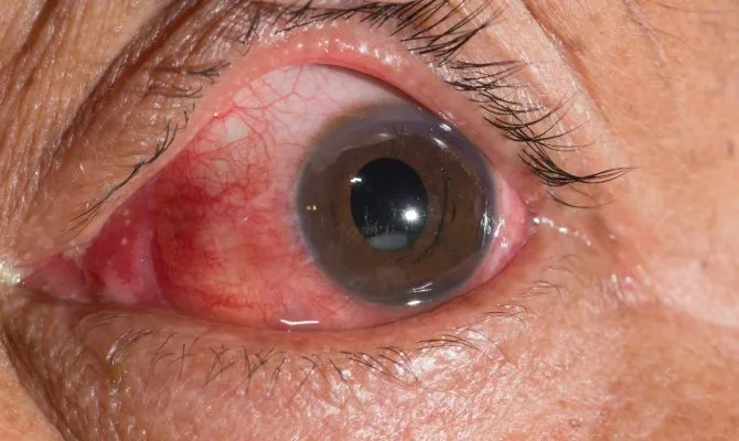 آب مروارید چشم چه علائمی دارد