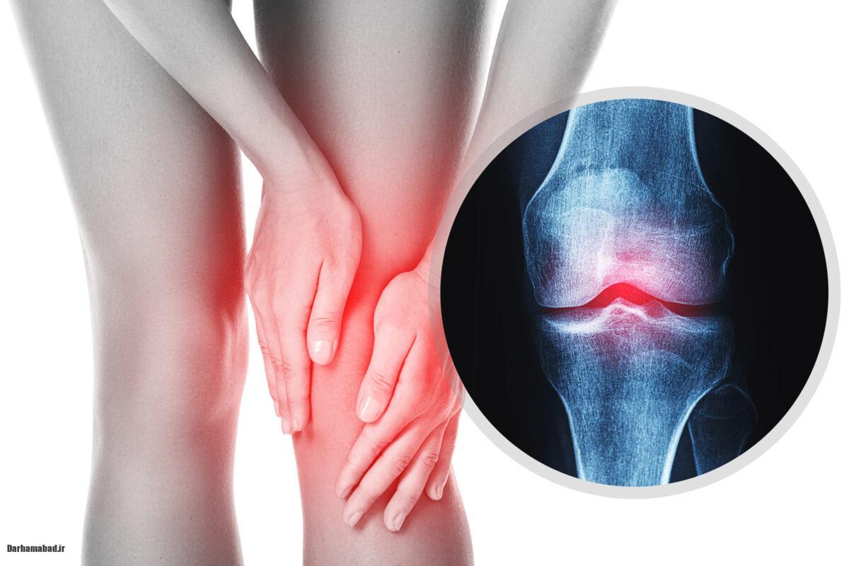 استئوآرتریت