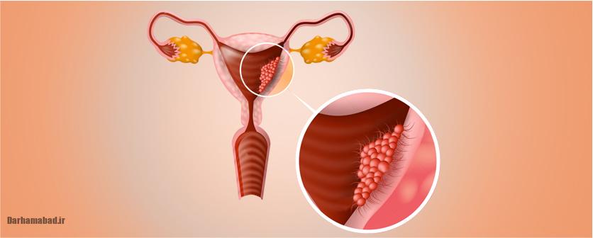 سرطان رحم چیست؟ (2)