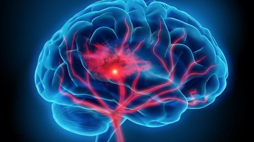 علائم حمله ایسکمی گذرا