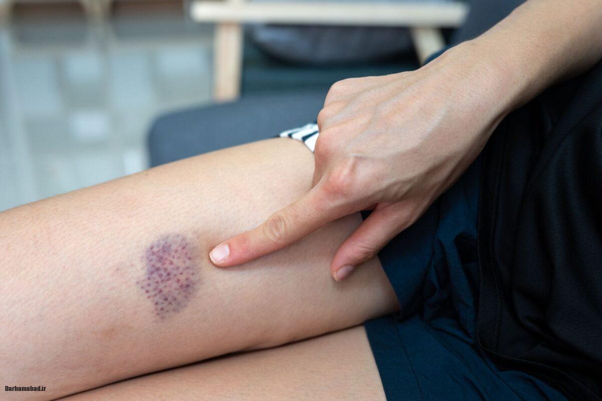 علائم لخته خون در بدن (2)