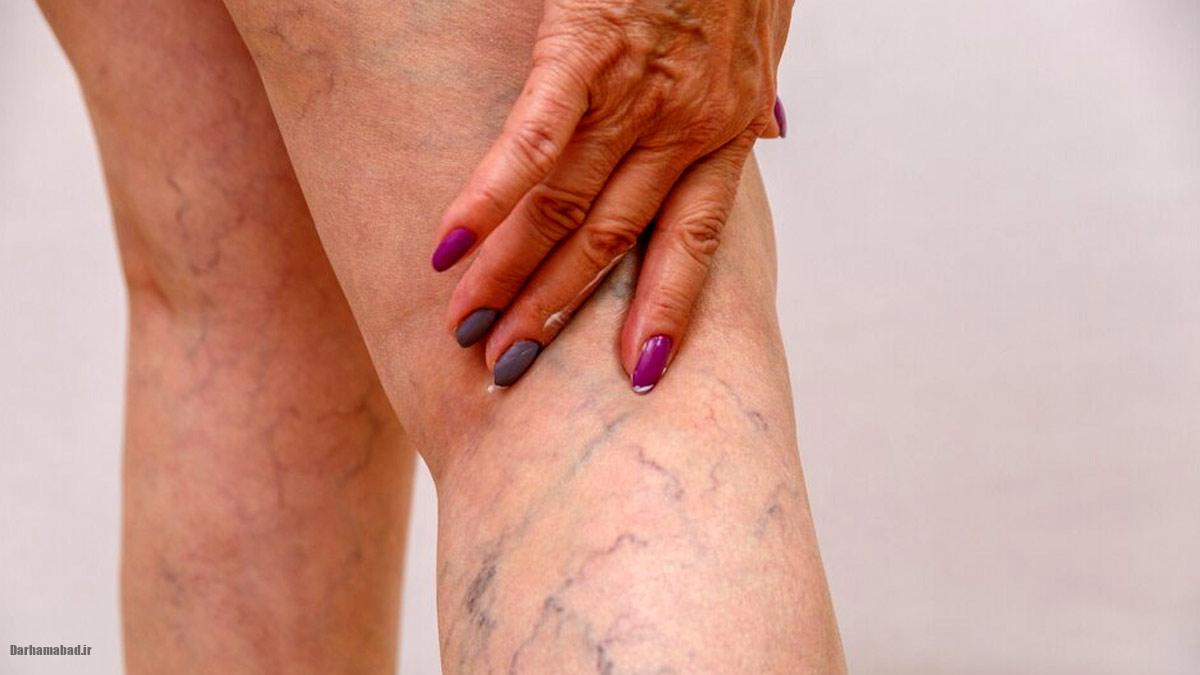 علائم لخته خون در بدن (3)