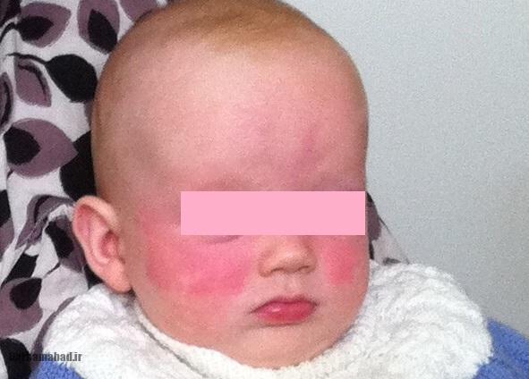 لوپوس نوزادی (2) لوپوس نوزادی (2)