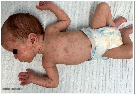لوپوس نوزادی لوپوس نوزادی