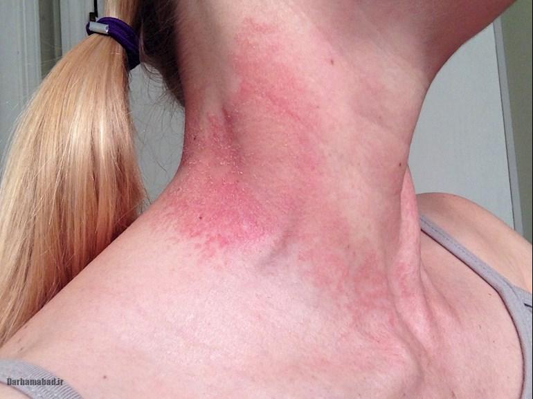 لوپوس پوستی (2) لوپوس پوستی (2)