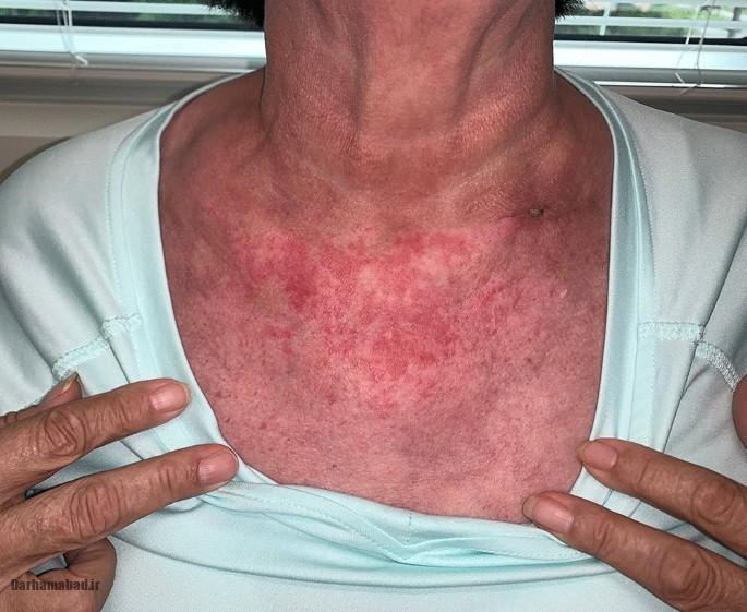 لوپوس پوستی (3)