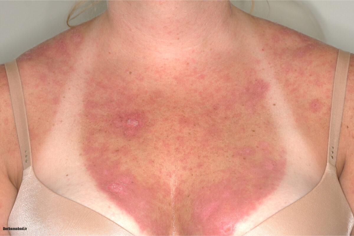 لوپوس پوستی لوپوس پوستی