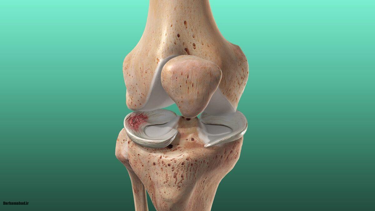 پارگی مینیسک زانو
